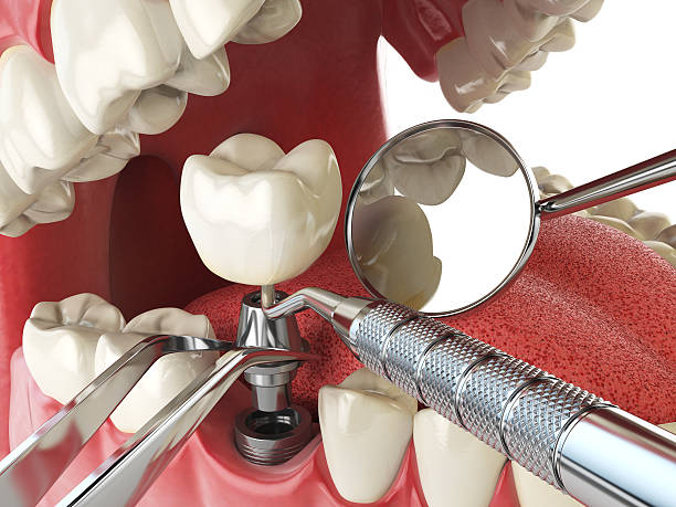 Best Emergency Dentist for Lost Fillings or Crowns in Junction City, OR